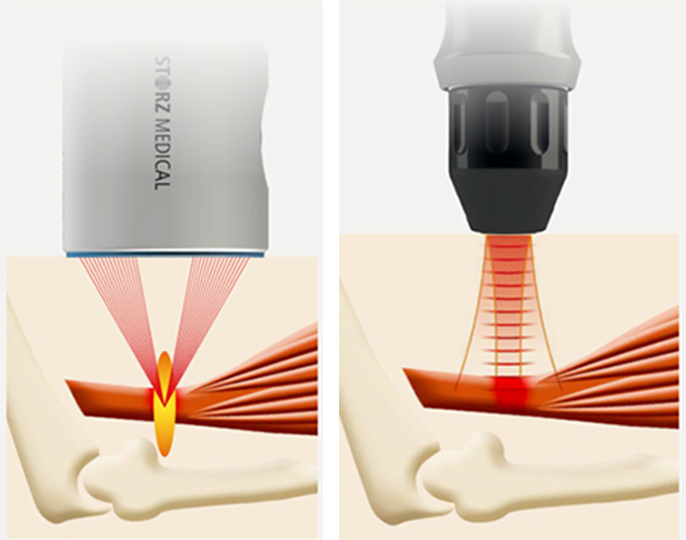 瑞江整形外科：体外衝撃波