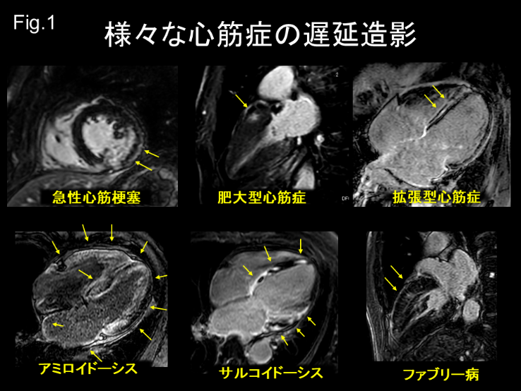 心臓遅延造影：不整脈患者における収縮期2心拍撮影のススメ | MRIfan.net