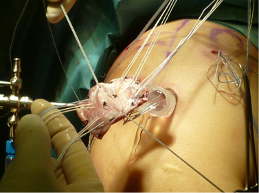 主な肩関節鏡手術 | 肩関節鏡手術の職人 鈴木隆