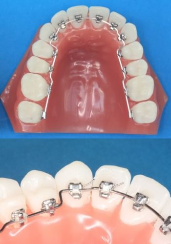 進化するストレートワイヤー | イーライン矯正歯科