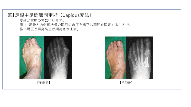 足の外科班｜臨床研究班｜整形外科学講座について｜東京慈恵会医科大学