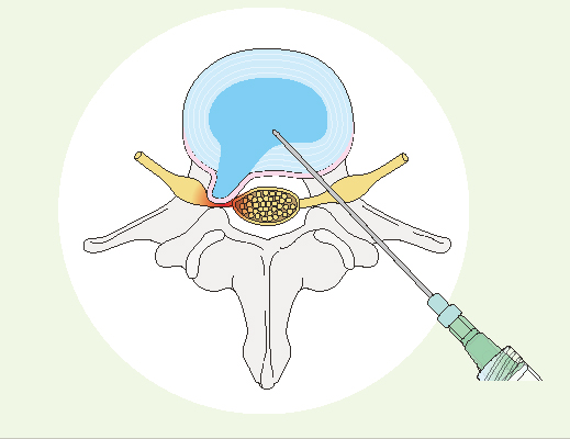 椎間板ヘルニア - はちや整形外科病院