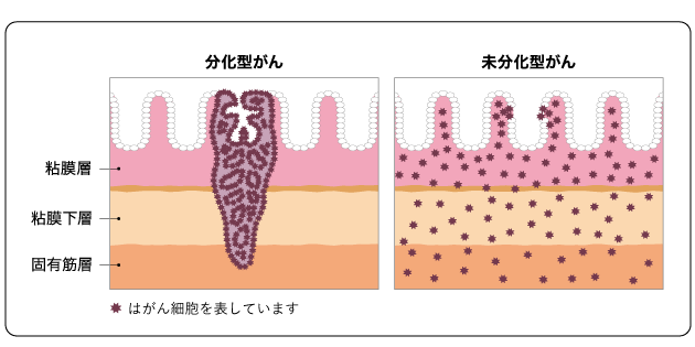 スキルス胃がんとは？原因・特徴・治療法から予後までを解説