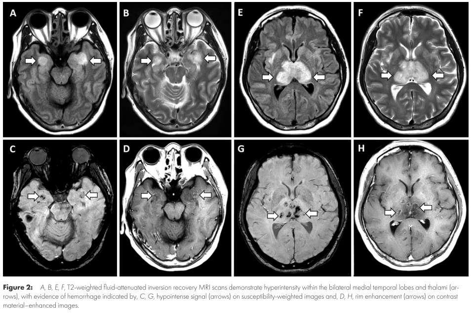 COVID19 神経合併症とその治療│医學事始 いがくことはじめ