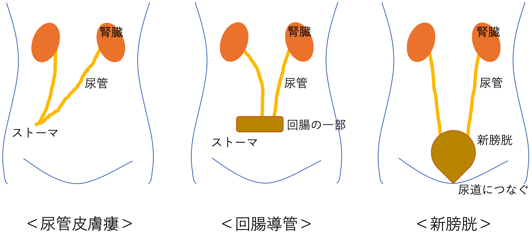 ロボット支援膀胱全摘除術（RARC） | 岩手医科大学 泌尿器科学講座