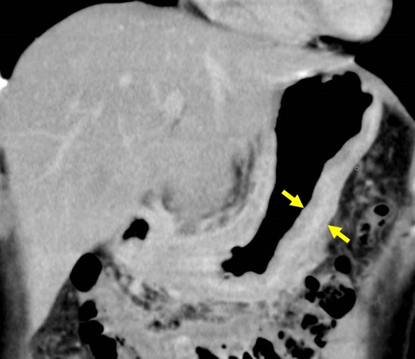 スキルス胃がんの新しい治療 | 東京大学医学部附属病院