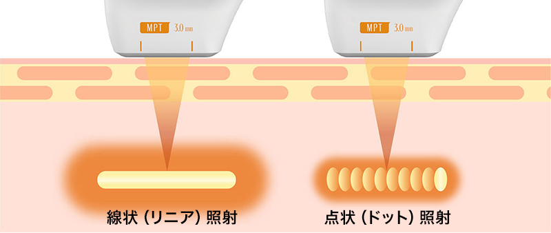 医療HIFU ウルトラフォーマーMPT | ZX-CLINIC【公式】｜大阪梅田・北