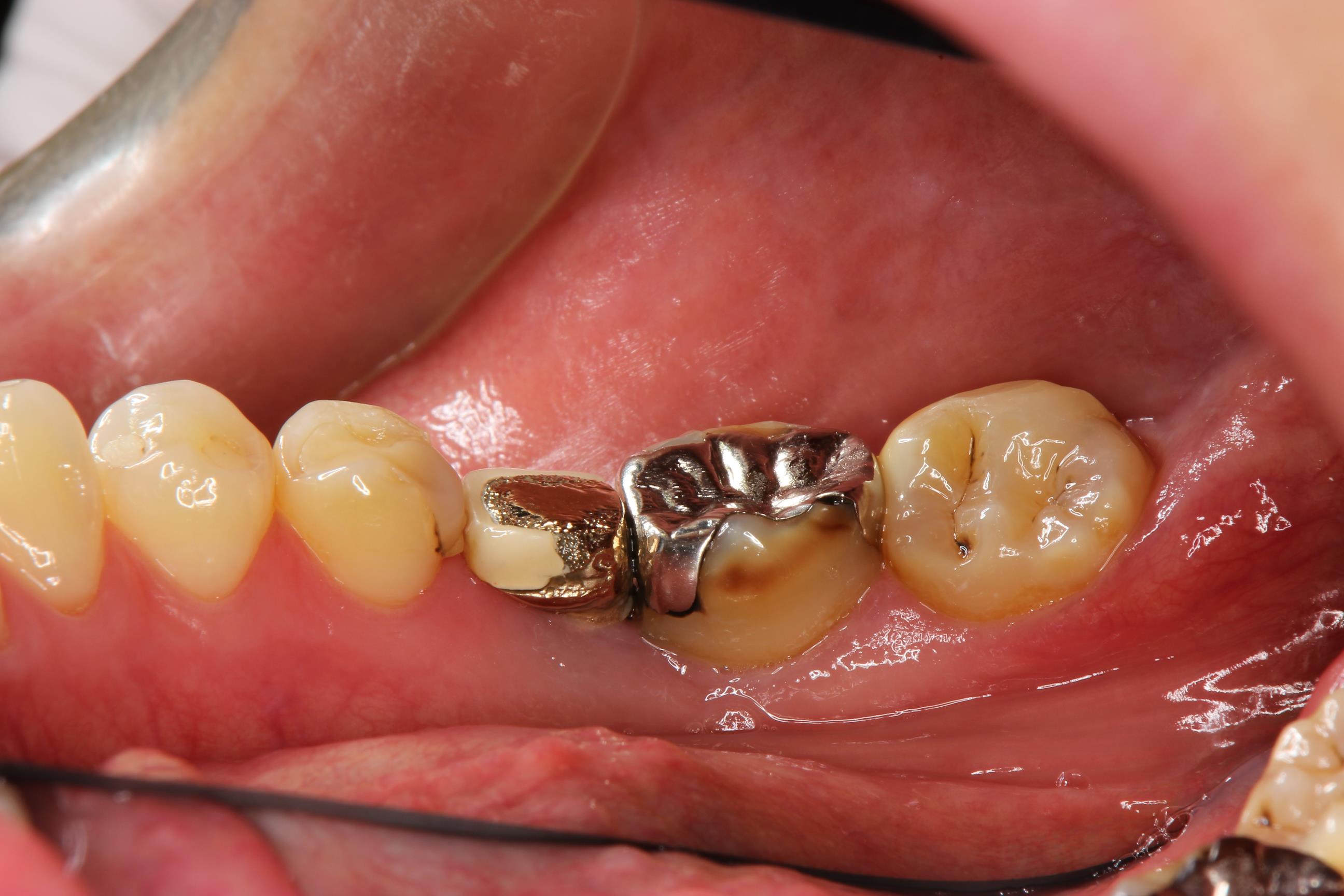 アンカースクリューを用いた歯の矯正 – 石神井公園 歯医者 – たけの