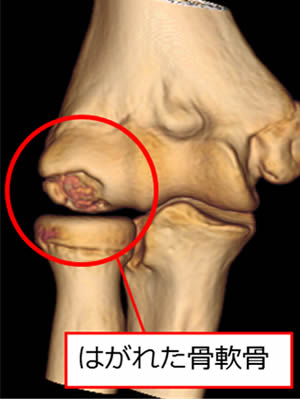 野球肘 手術 | あんしん病院