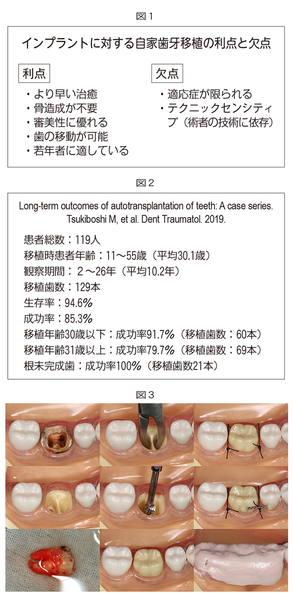自家歯牙移植 MIに基づく歯科臨床 04 自家歯牙移植 増補新版 (シリーズ MIに基づく歯科臨床) | 月星 光博