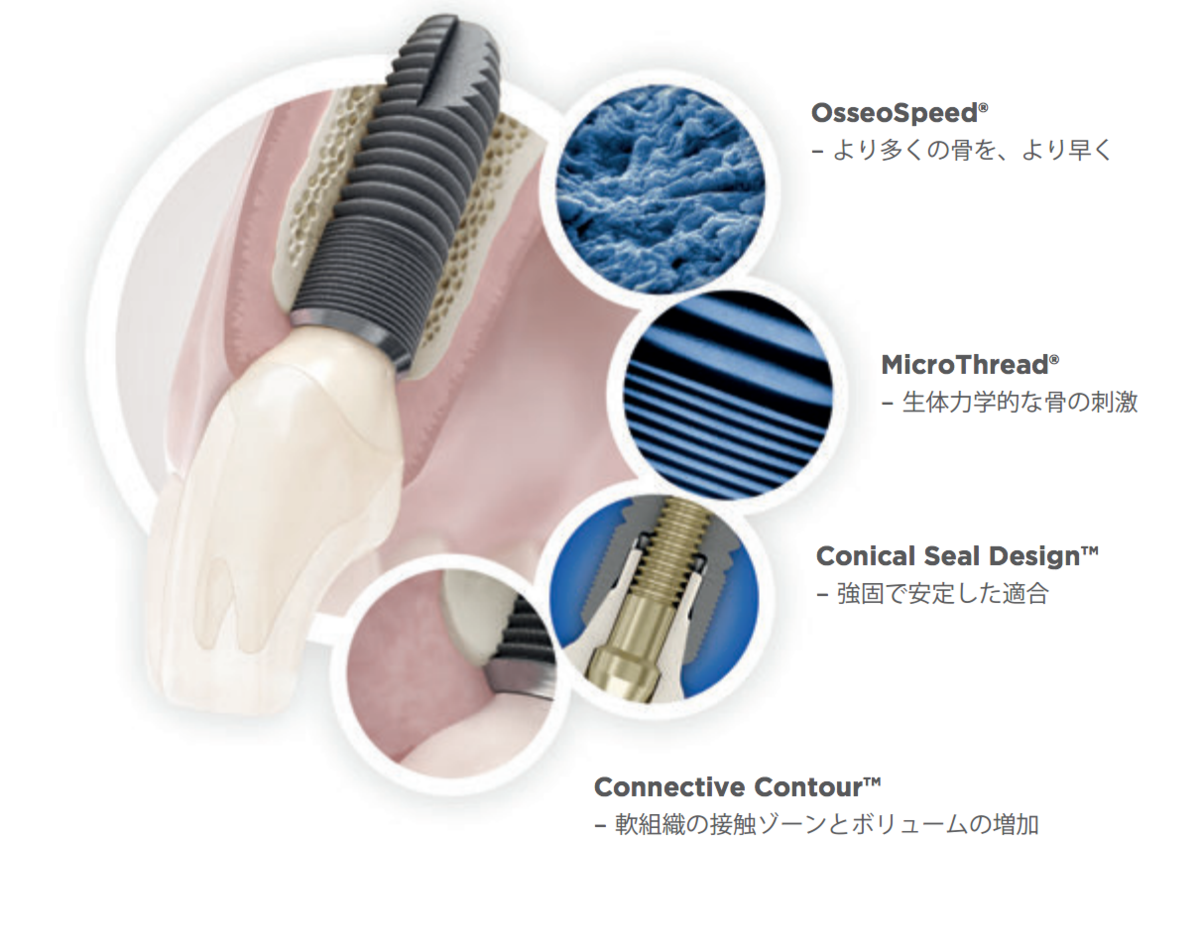 インプラント治療 - ひかりデンタルクリニック（岡崎市・額田郡幸田町）