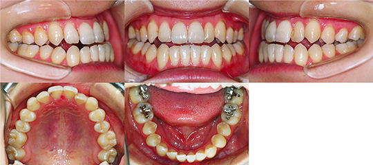 顎変形症の治療例一覧 | 顎変形症(外科的矯正治療)概説 | 広島中央矯正歯科