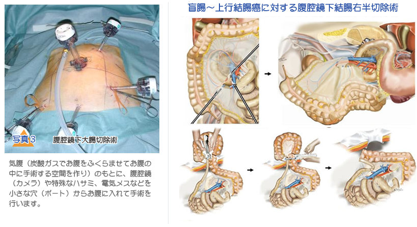 大腸疾患の外科治療について｜大腸がんの治療がわかる名医のWebサイト