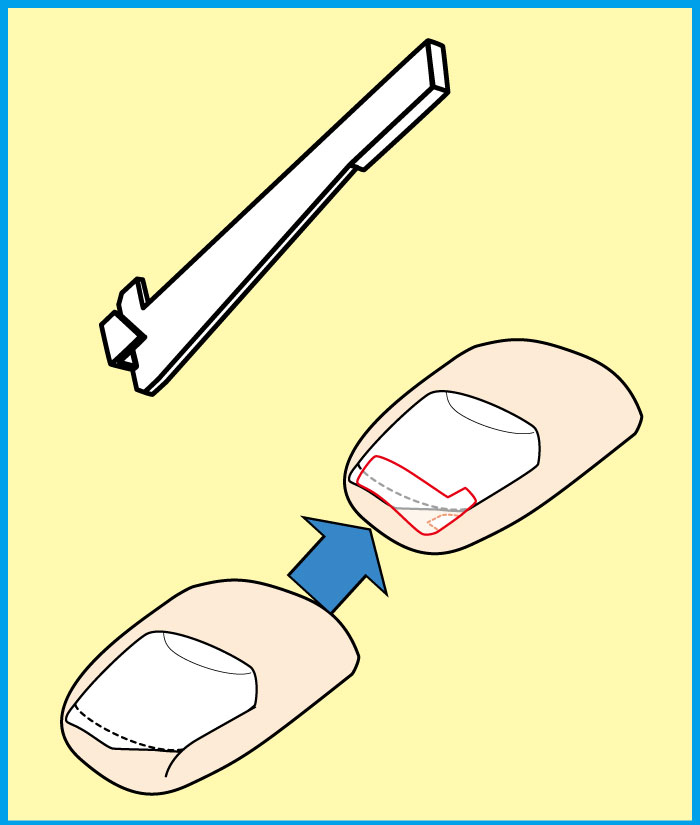 WFS使用方法/巻き爪補正（ペディグラス）