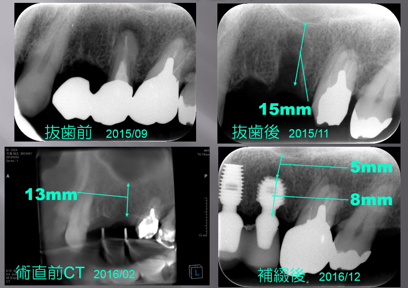 上顎洞底挙上術2｜小倉南区の歯医者 いけだ歯科矯正歯科