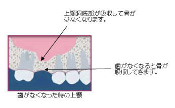 サイナスリフト完全解説｜上顎の骨造成でインプラントを可能にする手術