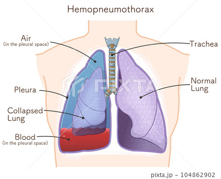 lungs,hemopneumothorax,illustration - Stock Illustration