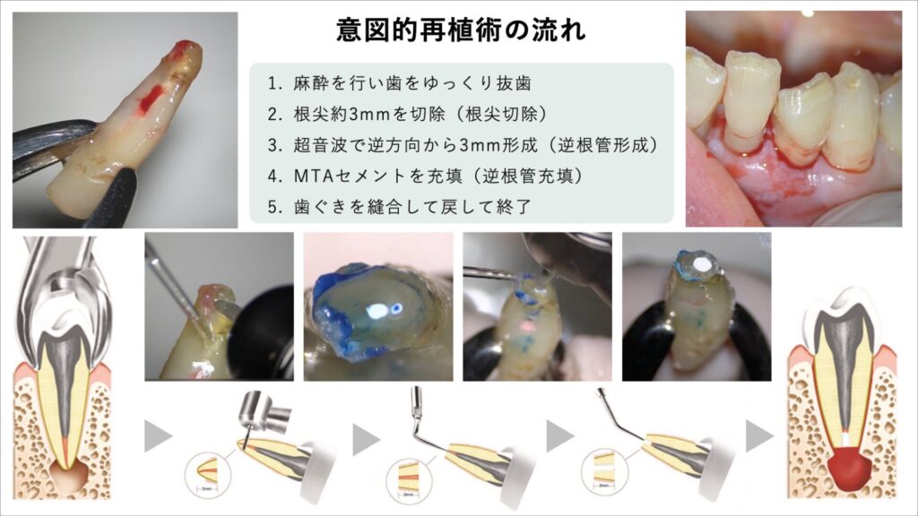 意図的再植術とは？歯を抜いて戻す特殊な根管治療で歯を残す方法
