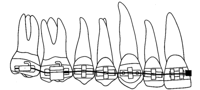 レベルアンカレッジシステム|【田隅矯正歯科クリニック】姫路駅直結の
