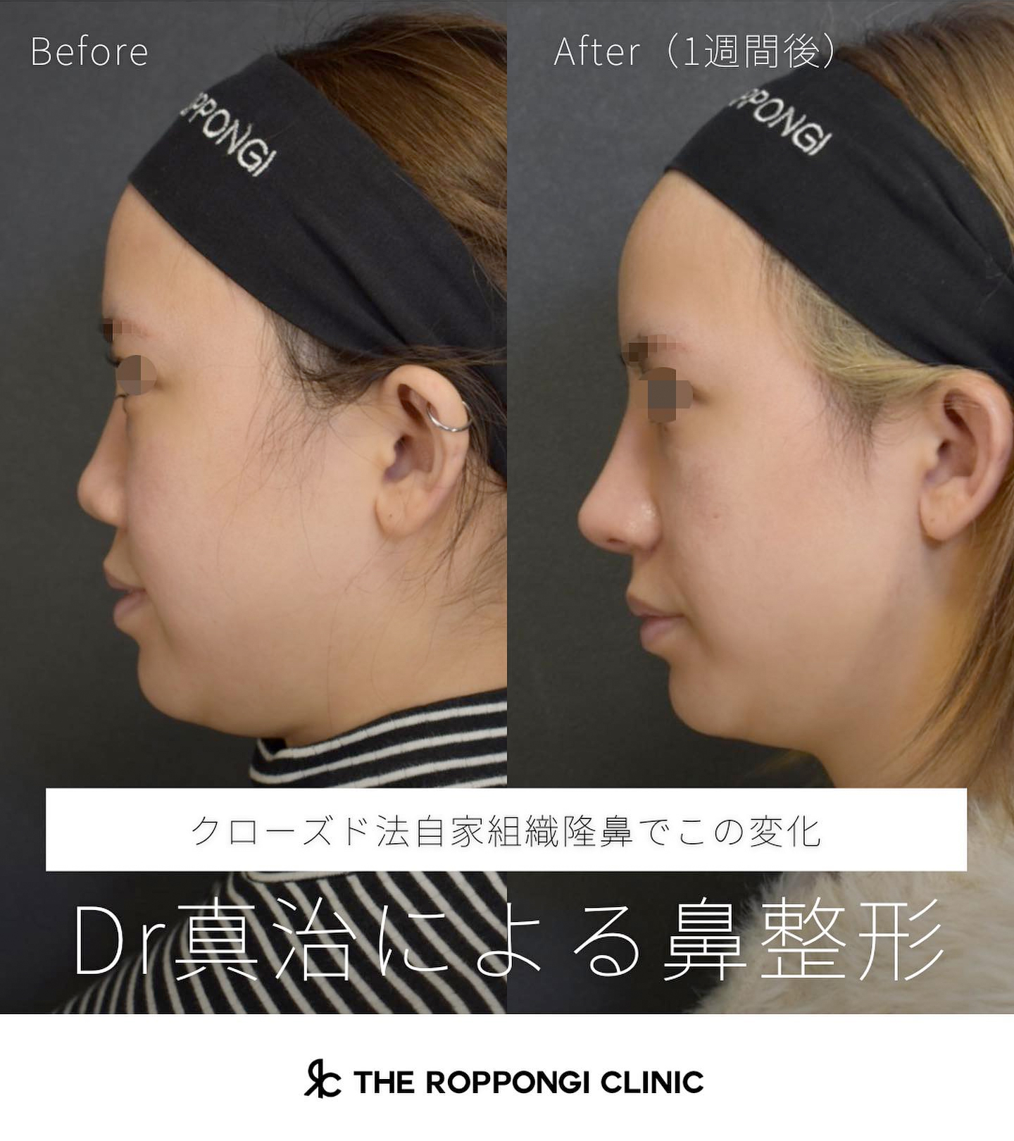 鼻整形（鼻を高く・小さく） | 六本木・恵比寿のTHE ROPPONGI CLINIC