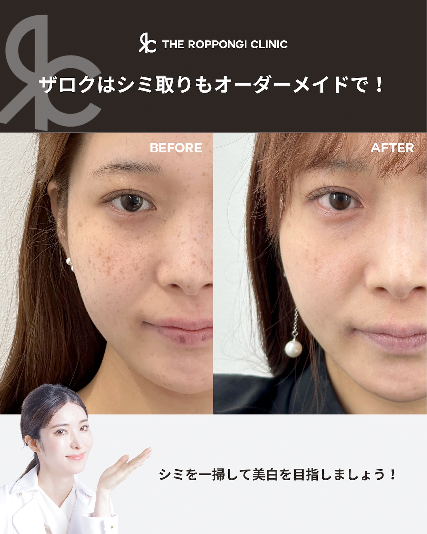 シミ取り（ピコレーザー） のビフォーアフター症例写真 ・画像| THE