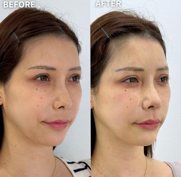 似合わせヒアルロン酸®（ヒアルロン酸注射） | 六本木・恵比寿のTHE