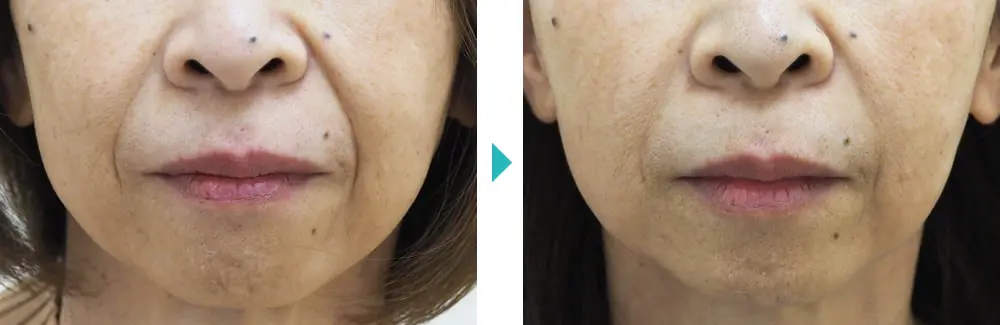 糸リフト（新世代スレッドリフト）によるほうれい線治療 | セオリー