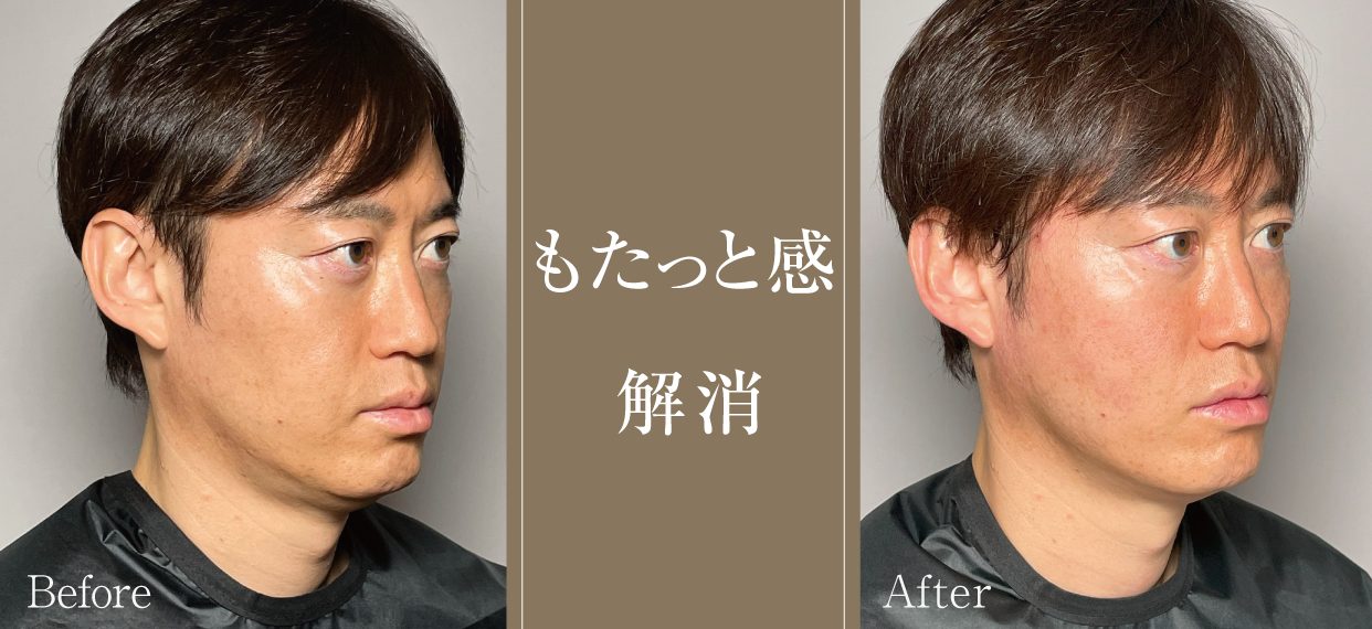 筒井裕介院長の糸リフトレポート | セオリークリニック- 東京・銀座の