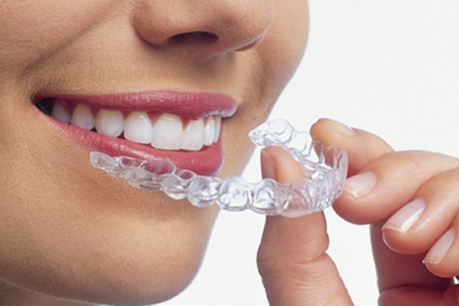 マウスピース矯正（アライナー矯正） - 盛岡（盛岡市）の歯医者、医療