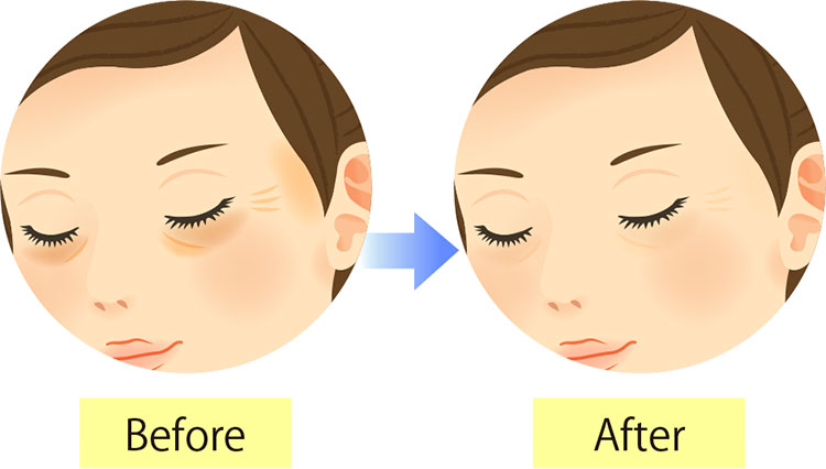 シワ取り（ボトックス）｜ボトックス｜美容整形のことなら東京形成美容