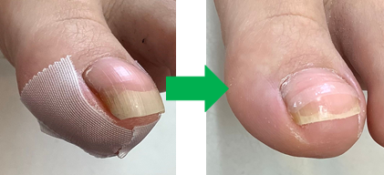 施術方法・流れ｜豊中の巻き爪ケア｜豊中駅より徒歩1分でアクセス抜群