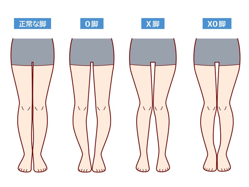 O脚矯正｜豊田まえやま接骨院
