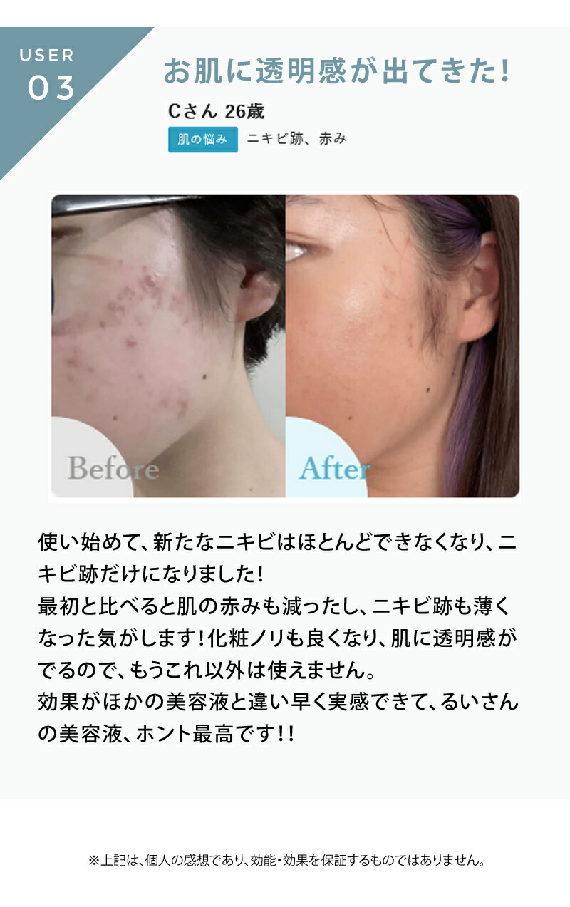 楽天市場】【送料無料/楽天1位/正規品】redeal. RD アクネ