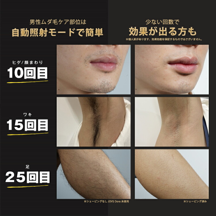 楽天市場】JOVS Dora1 J847モデル ピュアホワイト 脱毛器 ランキング1