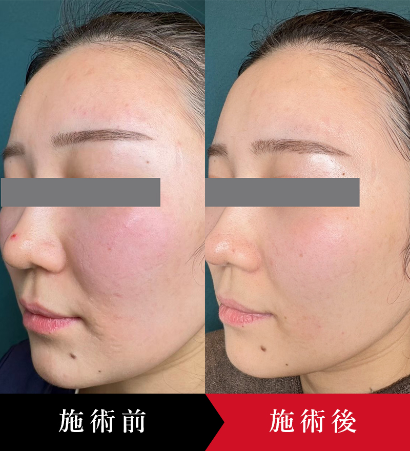 クレーターが治った！？滑らかな素肌へ導くダーマペンの実力とは