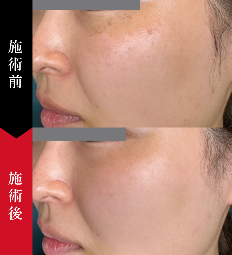 しみ・肝斑・そばかすの症例｜椿クリニック 銀座・名古屋・心斎橋