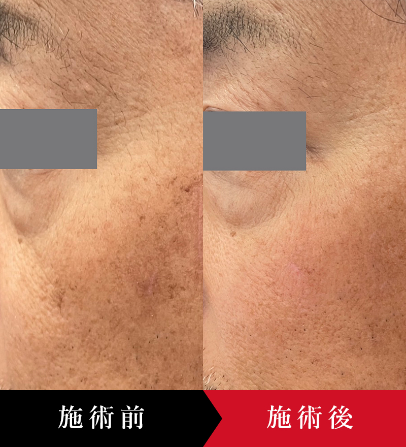 シミ取りレーザー (シミ取り放題) - 銀座・名古屋・心斎橋の美肌治療は