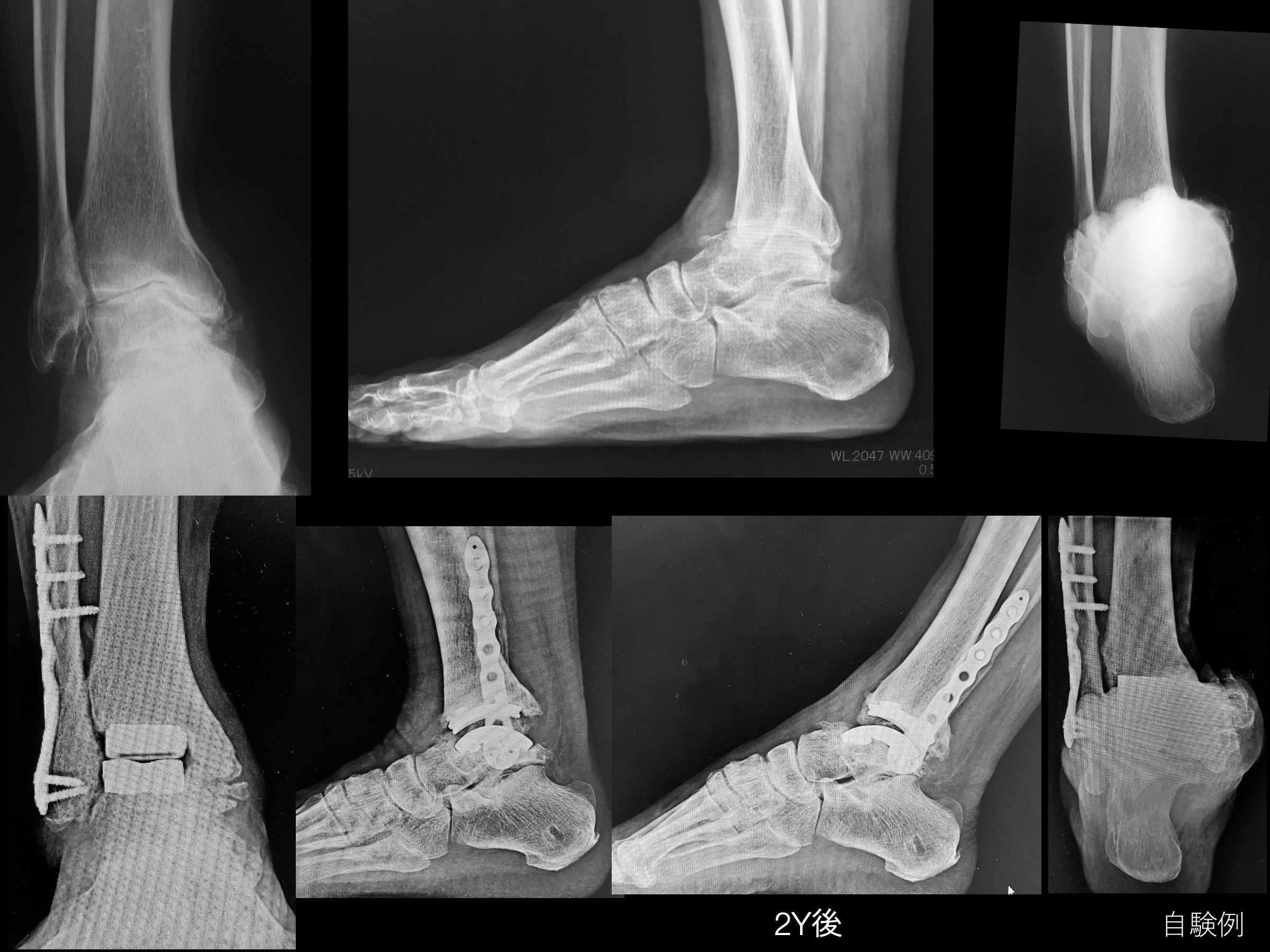 人工足関節置換手術 - 東京女子医科大学 膠原病リウマチ痛風センター