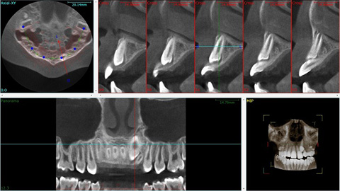 歯科用CT検査 | ひたちなか市の歯科・歯医者 | 津田歯科医院