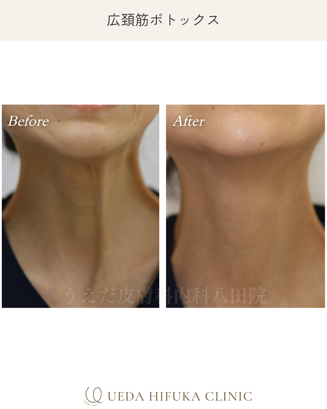 ヴィジョン・ド・ボーテ12個セット 高濃度シワとりクリーム塗る