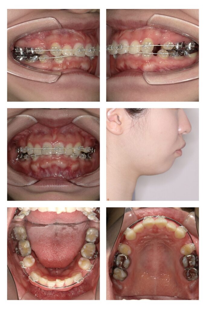 裏側矯正の種類 | 大阪梅田の矯正歯科専門医院 | 女性専用の【大阪オルソ】