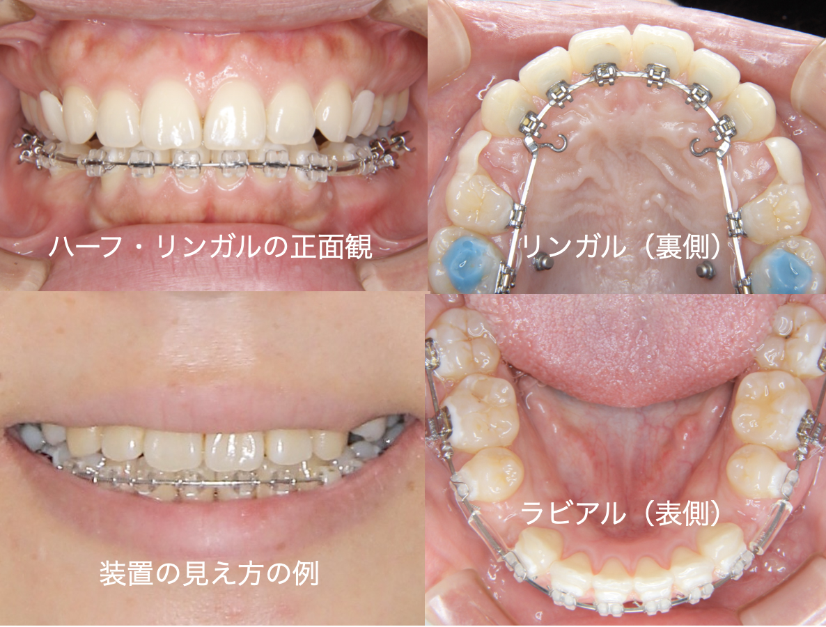 歯の裏側からの矯正 | 横浜の矯正歯科はSYNC横浜元町矯正歯科