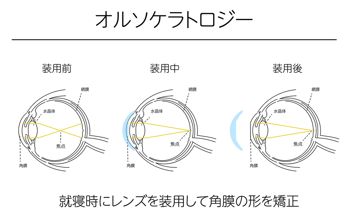 オルソケラトロジー｜札幌市中央区｜市立札幌病院前 ひゃくまち眼科