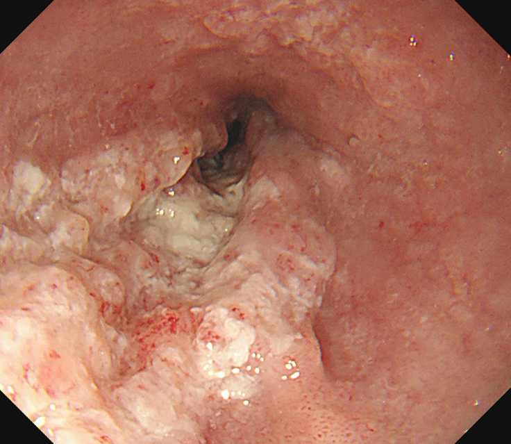 食道がんとは｜症状、検査から治療まで | 松戸市 千葉西総合病院