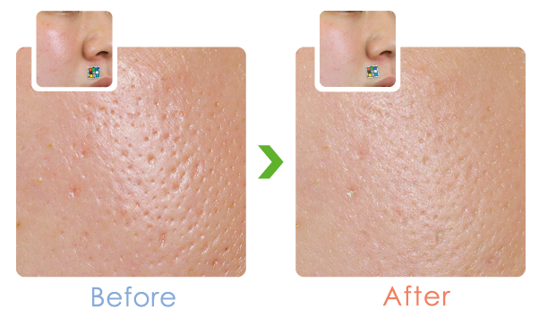 緑のパックでニキビさよなら美肌こんにちは - W・Sパスター