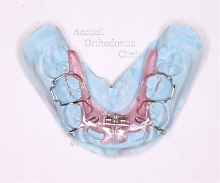 床矯正装置（拡大床、歯列の側方拡大に使用する矯正装置）｜アクイユ