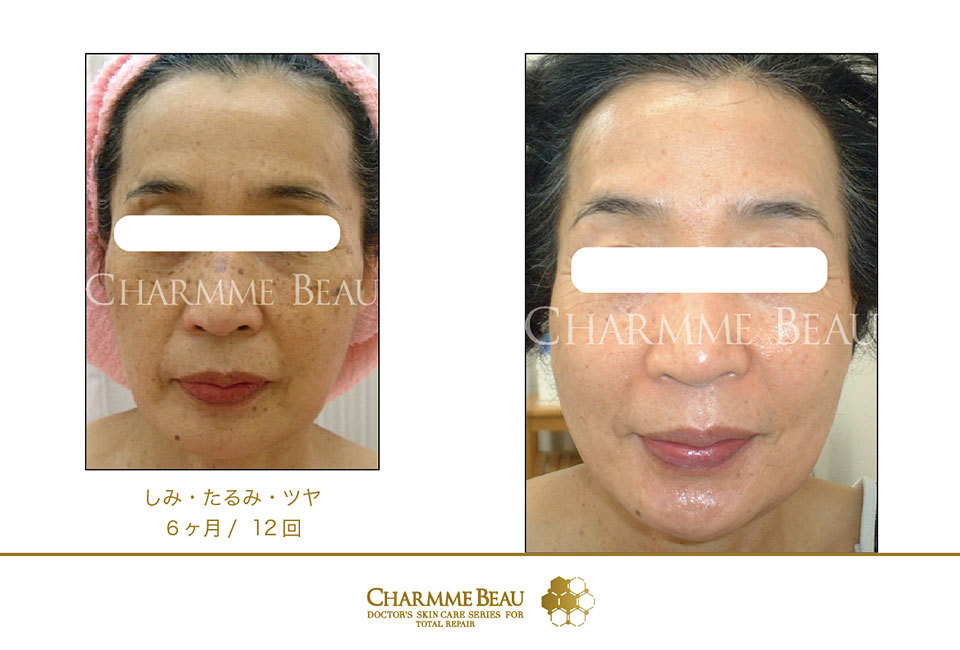 シャルム・ボー化粧品：フェイシャル：茨城県つくばのエステサロン