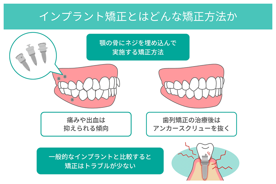 インプラント矯正って何？｜ 横浜でインプラント治療専門ならあきもと歯科
