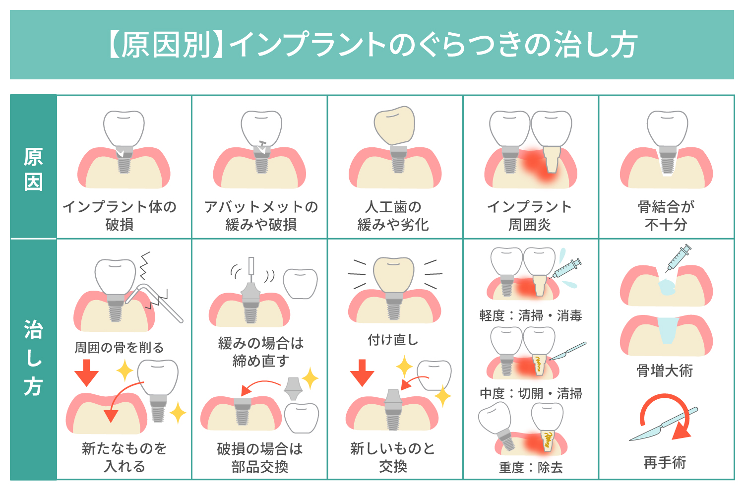 インプラントのぐらつきは治るの？ 放置するリスクと原因別の治し方を