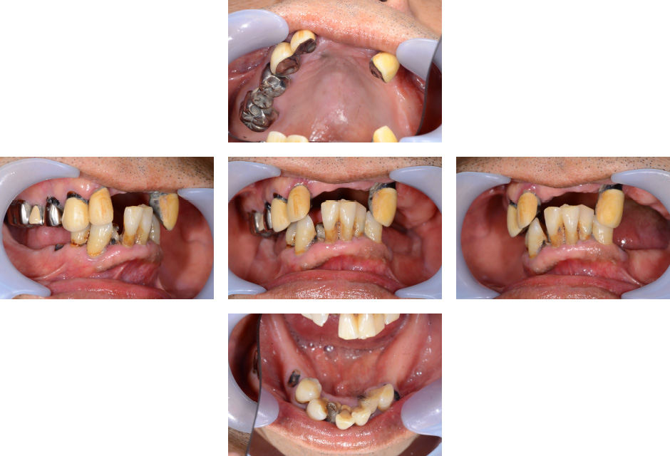 CASE04 インプラントを戦略的に利用し咬合再構成を行った症例 | 秋津の
